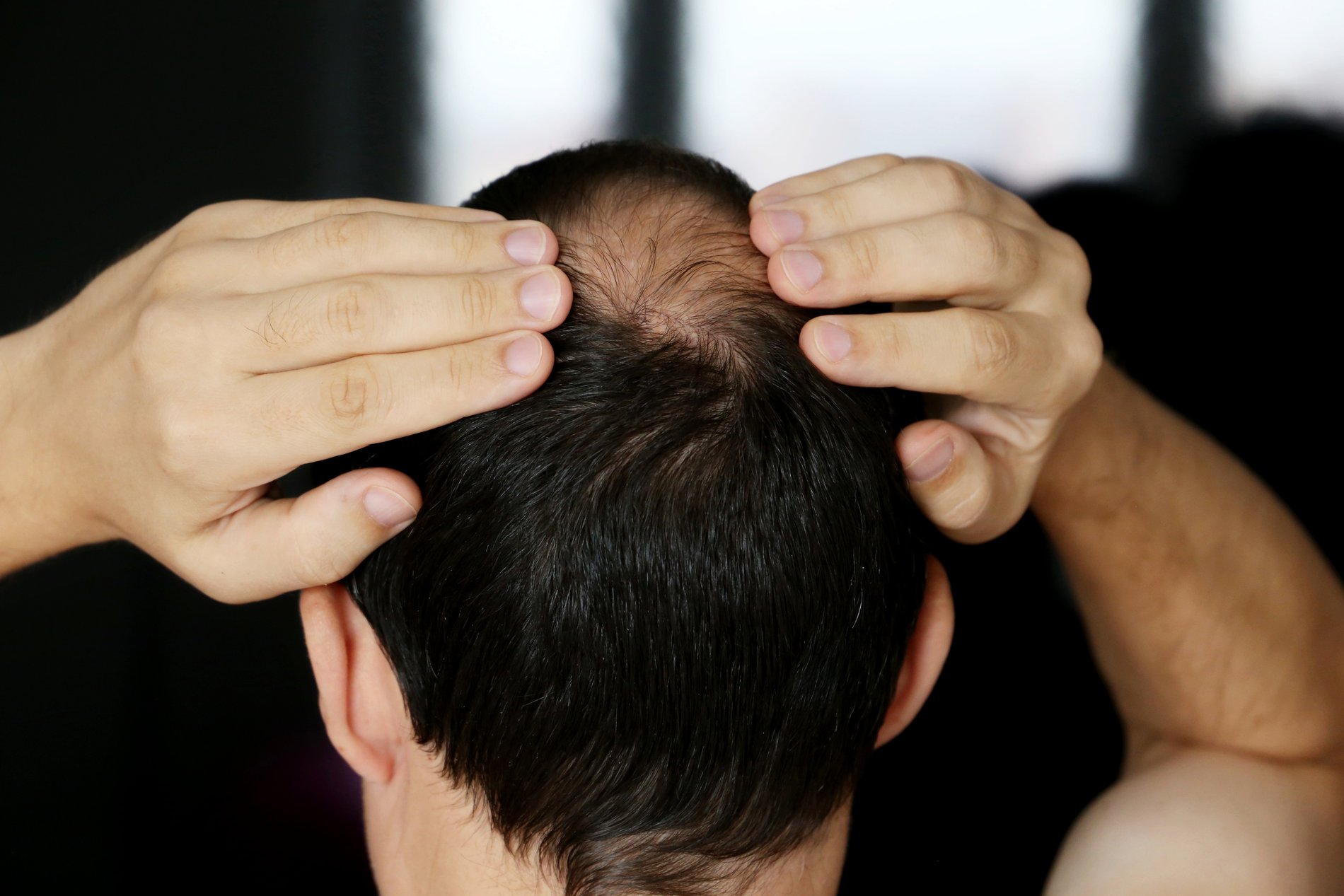 Navigating Hair Loss-image